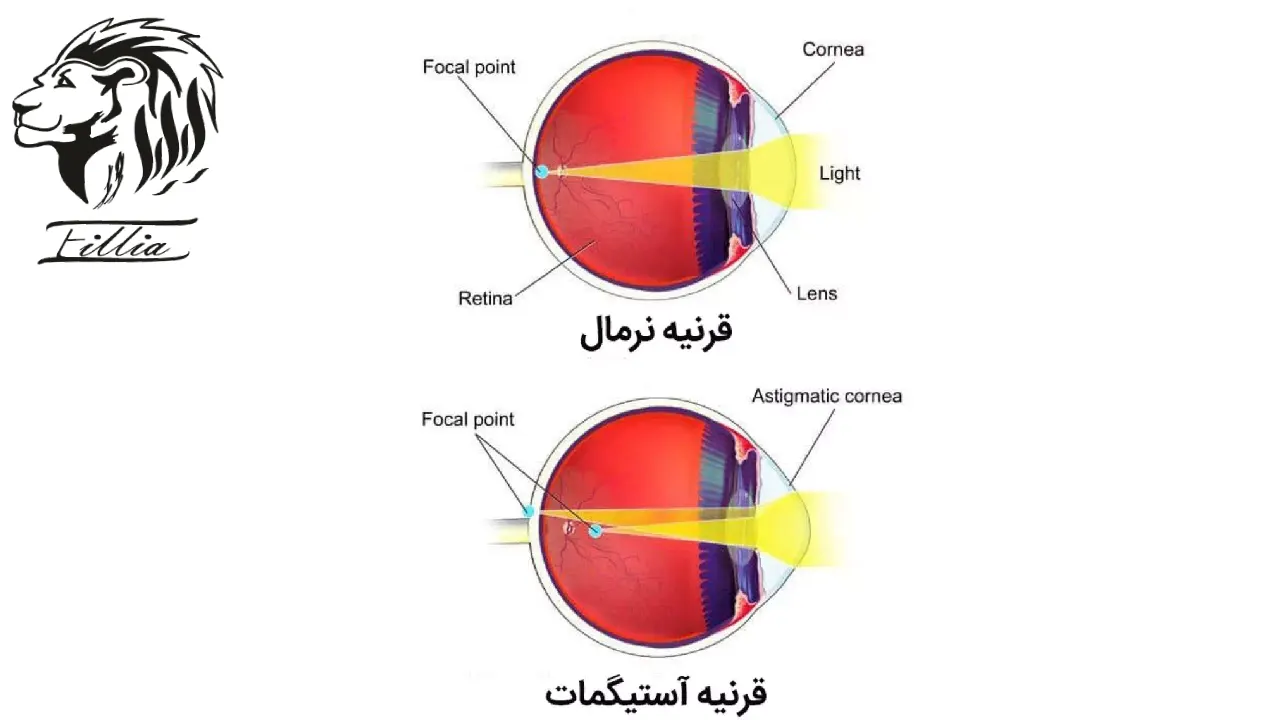 لنز طبی برای چشم آستیگمات